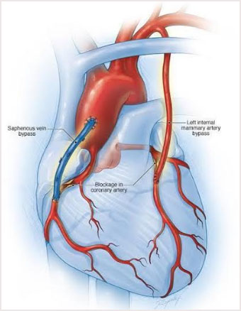 Coronary Artery Bypass Surgeries